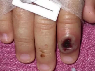 AS-Eropa Waspadai Penyebaran Virus Langka Cacar Monyet Yang Merebak
