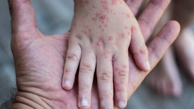 Monkeypox Persi Minta RS di Jateng Siaga