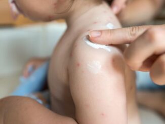 biang keringat bayi