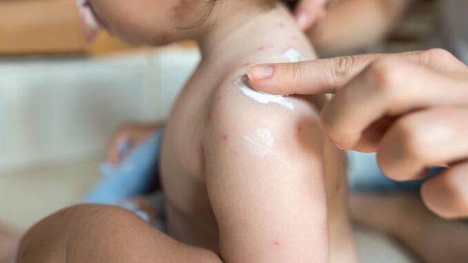 biang keringat bayi